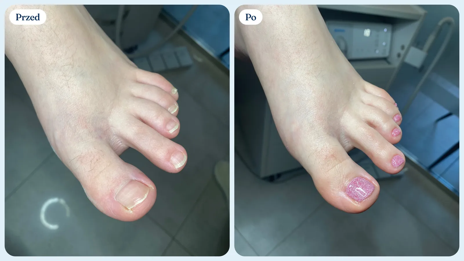 Przed i po: paznokcie stóp przed zabiegiem i po pedicure z hybrydą na dużym palcu