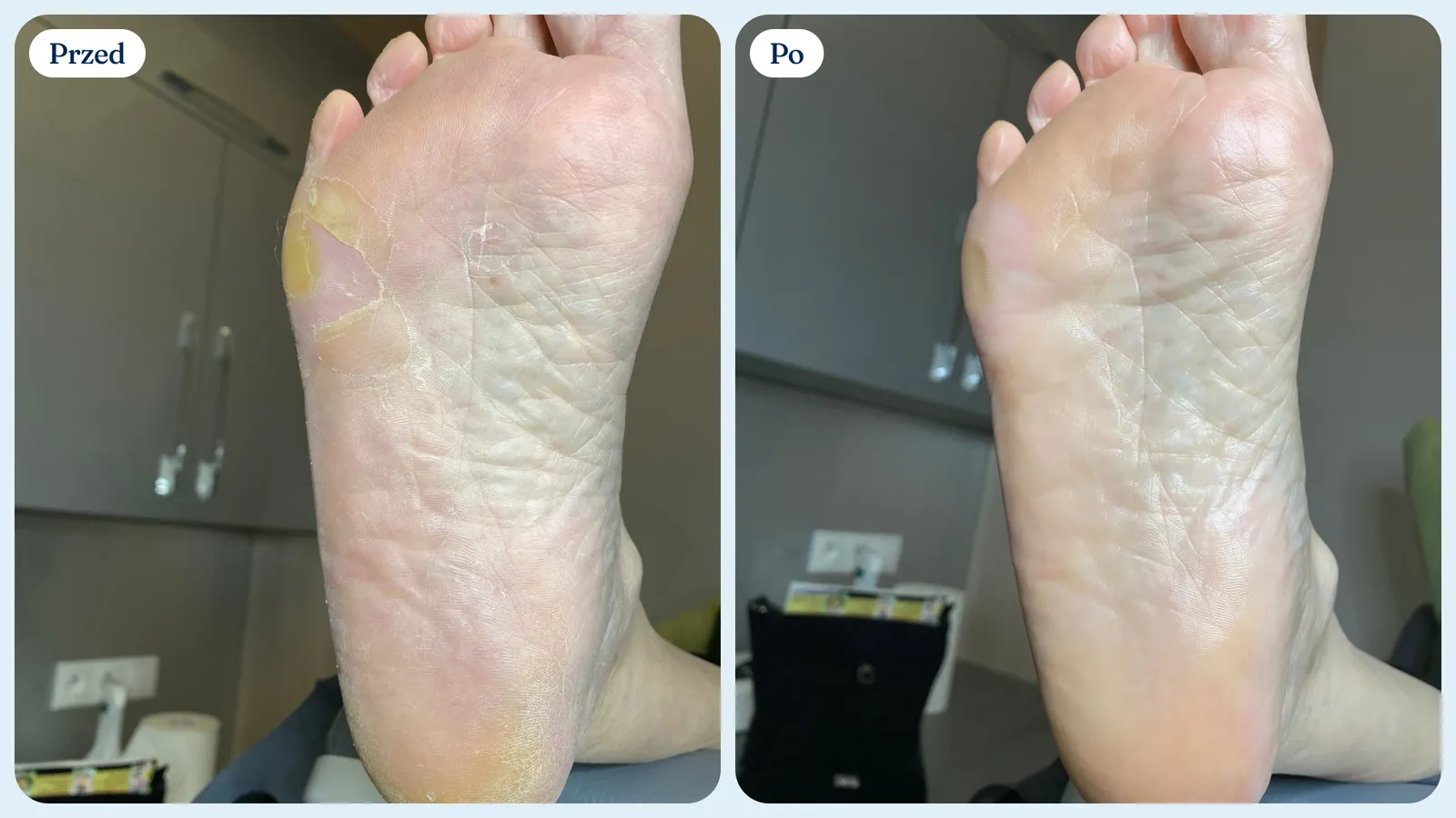 Przed i po: zrogowacenia na podeszwie stopy i ta sama podeszwa wygładzona po pedicure podologicznym